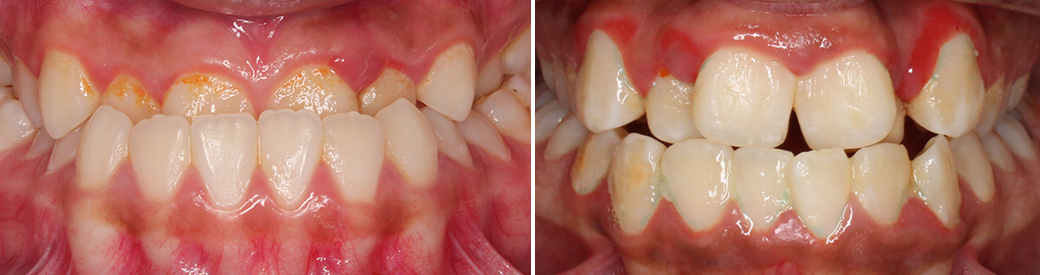 Anterior Crossbite | Posterior Crossbite | Crossbites | What is a Crossbite | Orthodontist | Orthodontics | Chicago Orthodontist | Bubbly Moments | Emilia Taneva