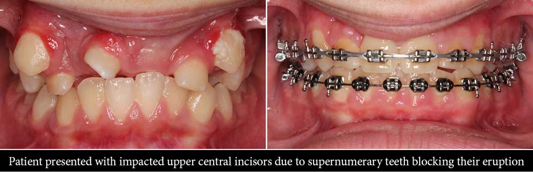 Impacted Teeth | Impacted Wisdom Teeth | Braces | Oral Surgery | Bubbly Moments