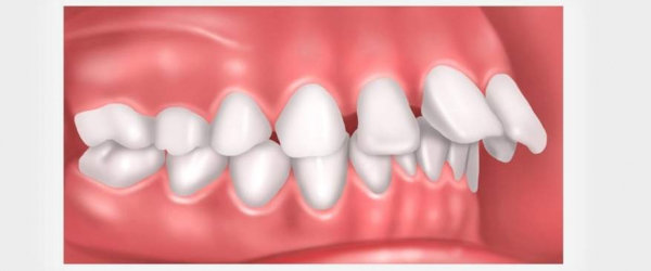 Overjet Vs Overbite How Are They Different